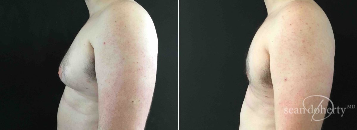Patient 4737, Gynecomastia Before and After Photos Gynecomastia Before and After Photos in Boston, MA, Patient 4737