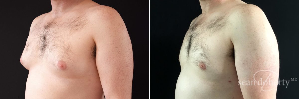 Gynecomastia Before and After Photos in Boston, MA, Patient 5194