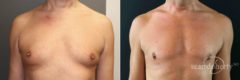 Gynecomastia Before and After Photos in Boston, MA, Patient 5204