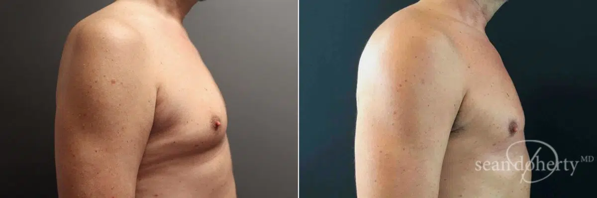 Gynecomastia Before and After Photos in Boston, MA, Patient 5204