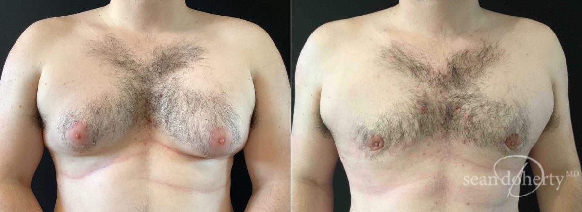 Patient 4737, Gynecomastia Before and After Photos Gynecomastia Before and After Photos in Boston, MA, Patient 4737