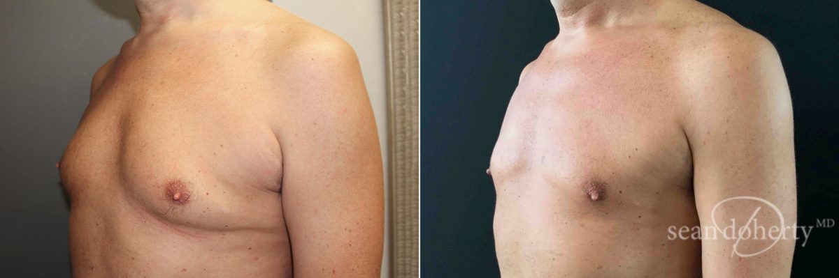 Gynecomastia Before and After Photos in Boston, MA, Patient 5204