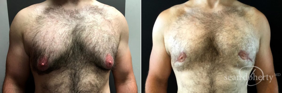 Patient 5184, Gynecomastia Before and After Photos Gynecomastia Before and After Photos in Boston, MA, Patient 5184