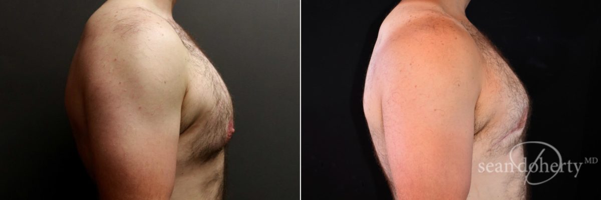 Patient 5184, Gynecomastia Before and After Photos Gynecomastia Before and After Photos in Boston, MA, Patient 5184