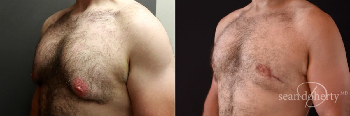 Patient 5184, Gynecomastia Before and After Photos Gynecomastia Before and After Photos in Boston, MA, Patient 5184