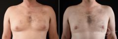 Gynecomastia Before and After Photos in Boston, MA, Patient 5194