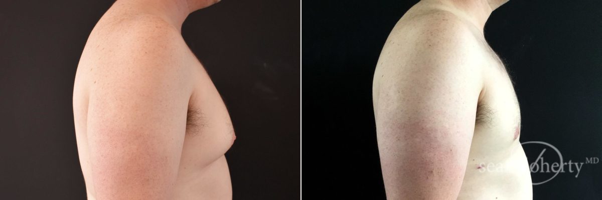 Gynecomastia Before and After Photos in Boston, MA, Patient 5194