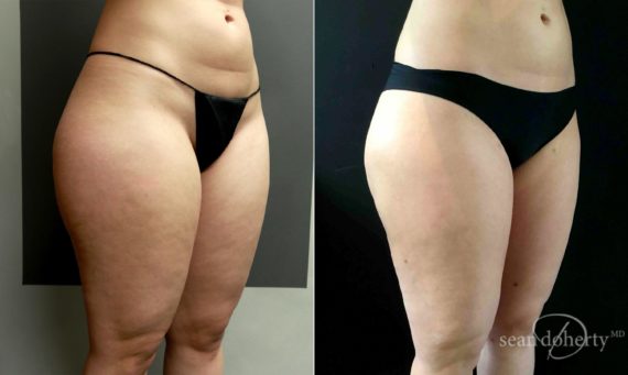 Liposuction Before and After Photos in Boston, MA, Patient 5047