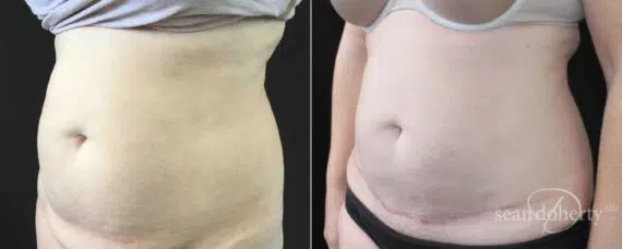 Tummy Tuck Before and After Photos in Boston, MA, Patient 5168