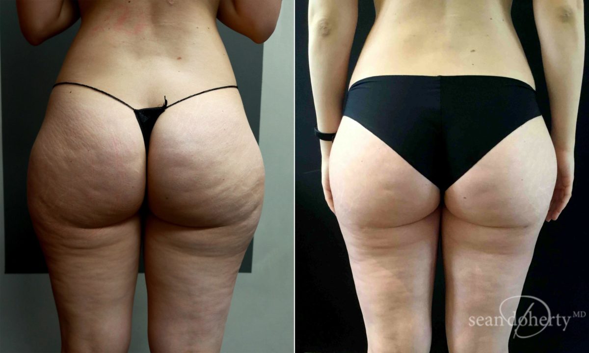 Liposuction Before and After Photos in Boston, MA, Patient 5047