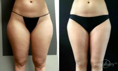 Liposuction Before and After Photos in Boston, MA, Patient 5047