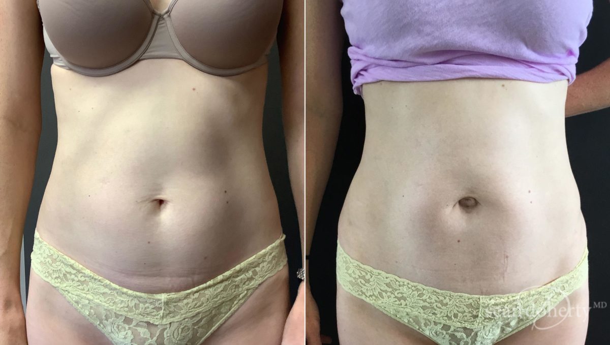 Tummy Tuck (Abdominoplasty), Woman - Age 40 - Before & After Photos