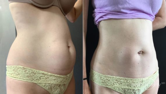 Tummy Tuck Before and After Photos in Boston, MA, Patient 5110