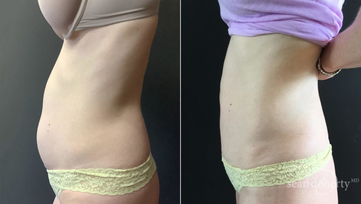 Tummy Tuck Before and After Photos in Boston, MA, Patient 5110