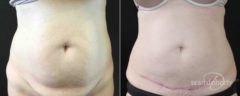 Tummy Tuck Before and After Photos in Boston, MA, Patient 5168