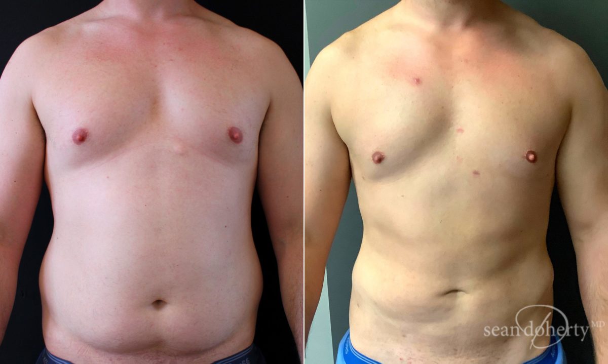Patient 5039, Male Liposuction Before and After Photos Male Liposuction Before and After Photos in Boston, MA, Patient 5039