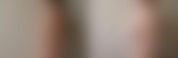 Breast Augmentation Before and After Photos in Boston, MA, Patient 2379