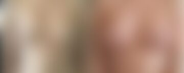 Breast Augmentation Before and After Photos in Boston, MA, Patient 4681