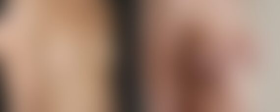 Breast Augmentation Before and After Photos in Boston, MA, Patient 4681