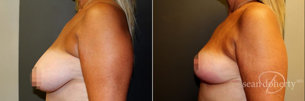 Patient 4773, Breast Reduction Before and After Photos Breast Reduction Before and After Photos in Boston, MA, Patient 4773