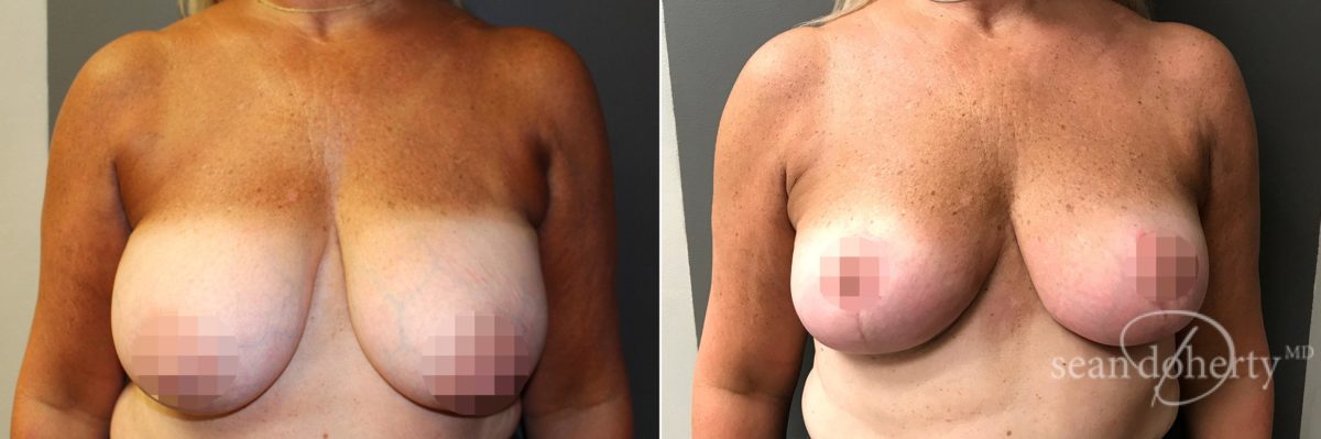 Patient 4773, Breast Reduction Before and After Photos Breast Reduction Before and After Photos in Boston, MA, Patient 4773