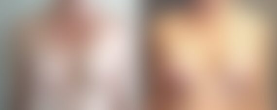 Breast Lift with Implants Before and After Photos in Boston, MA, Patient 5100