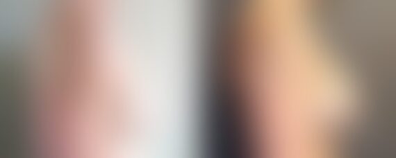Breast Lift with Implants Before and After Photos in Boston, MA, Patient 5100