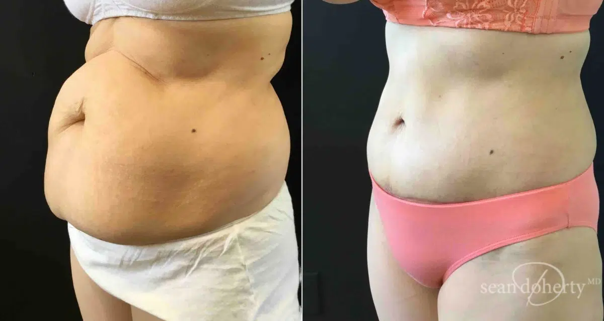 Tummy Tuck Before and After Photos in Boston, MA, Patient 4638