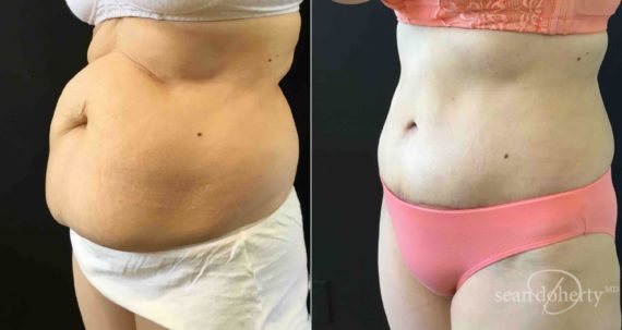 Mini Tummy Tuck Maryland, Baltimore