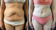 Tummy Tuck Before and After Photos in Boston, MA, Patient 4638