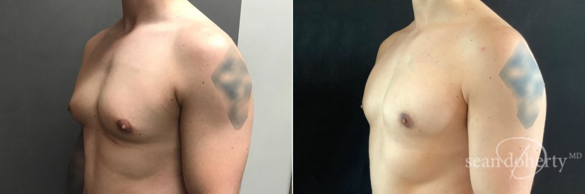 Gynecomastia Before and After Photos in Boston, MA, Patient 4744