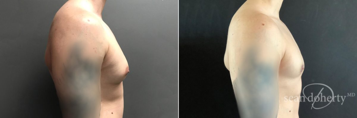 Gynecomastia Before and After Photos in Boston, MA, Patient 4744