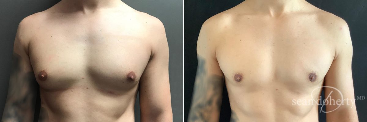 Gynecomastia Before and After Photos in Boston, MA, Patient 4744