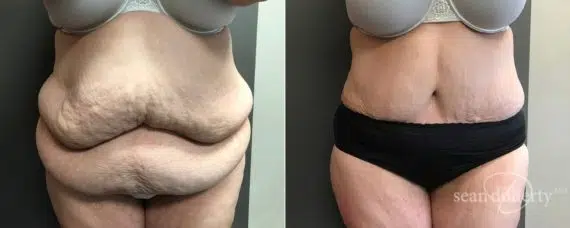 Tummy Tuck Before and After Photos in Boston, MA, Patient 5120