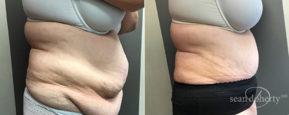 Tummy Tuck Before and After Photos in Boston, MA, Patient 5120