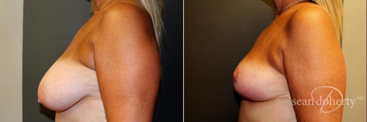 Patient 4773, Breast Reduction Before and After Photos Breast Reduction Before and After Photos in Boston, MA, Patient 4773