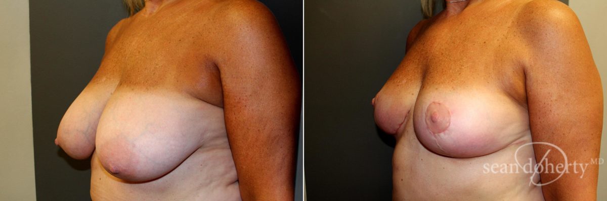 Patient 4773, Breast Reduction Before and After Photos Breast Reduction Before and After Photos in Boston, MA, Patient 4773