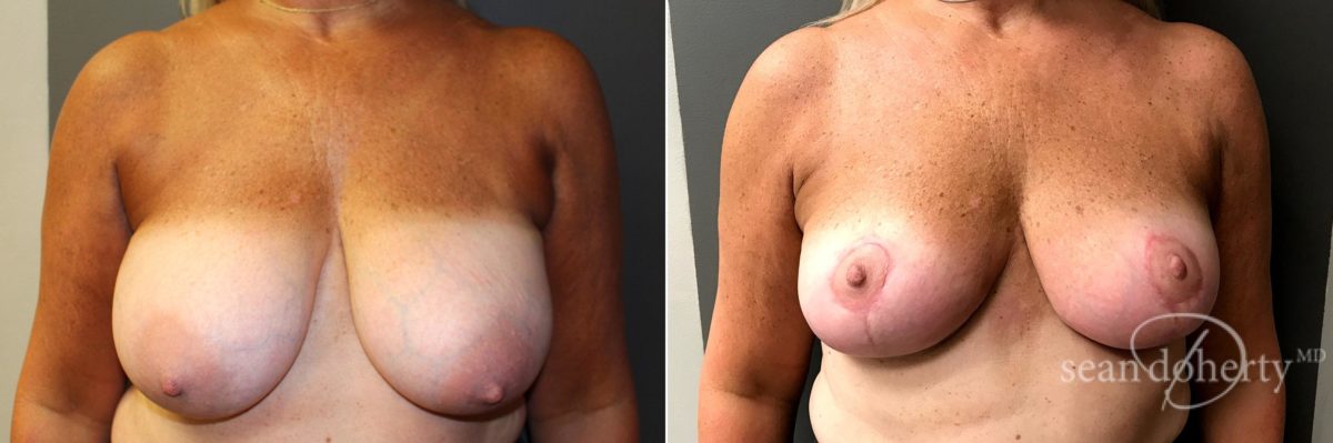 Patient 4773, Breast Reduction Before and After Photos Breast Reduction Before and After Photos in Boston, MA, Patient 4773
