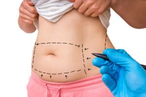 How Much Does a Tummy Tuck Cost?