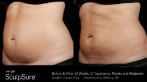 Sculpsure Candidate