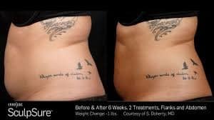 SculpSure works by having your body safely naturally and painlessly absorb and metabolize unwanted fat cells.