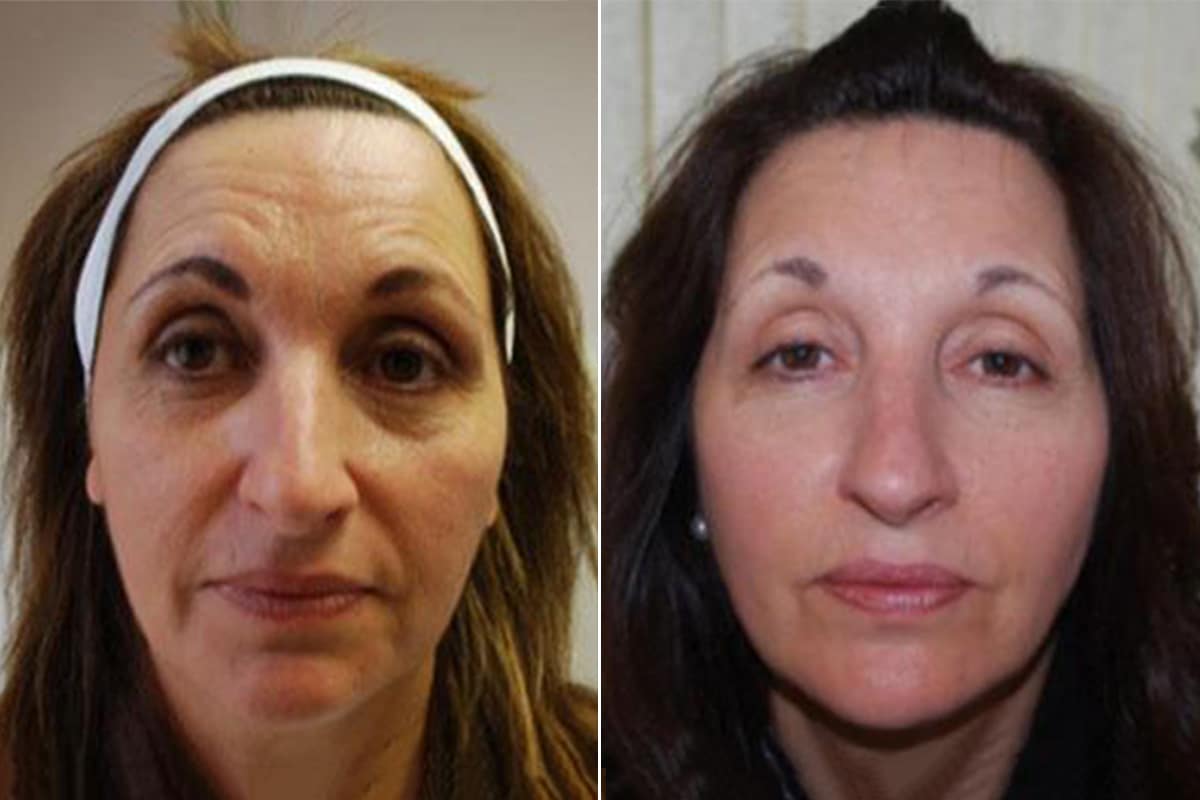 Juvederm Voluma Before And After