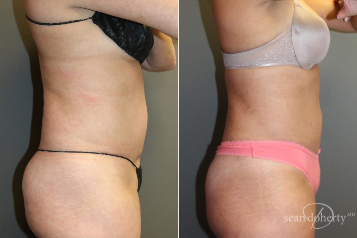 Liposuction Before and After Photos in Boston, MA, Patient 5750