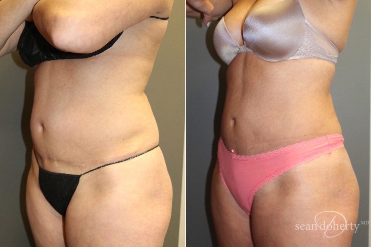 Liposuction Before and After Photos