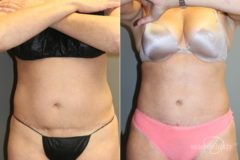 Liposuction Before and After Photos in Boston, MA, Patient 5750