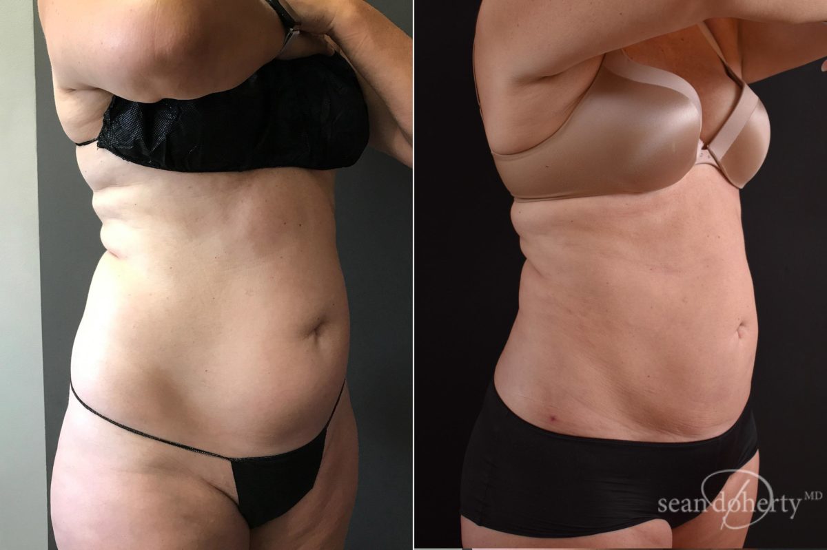Patient 5760, Liposuction Before and After Photos Liposuction Before and After Photos in Boston, MA, Patient 5760