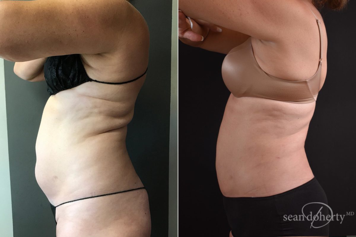Patient 5760, Liposuction Before and After Photos Liposuction Before and After Photos in Boston, MA, Patient 5760
