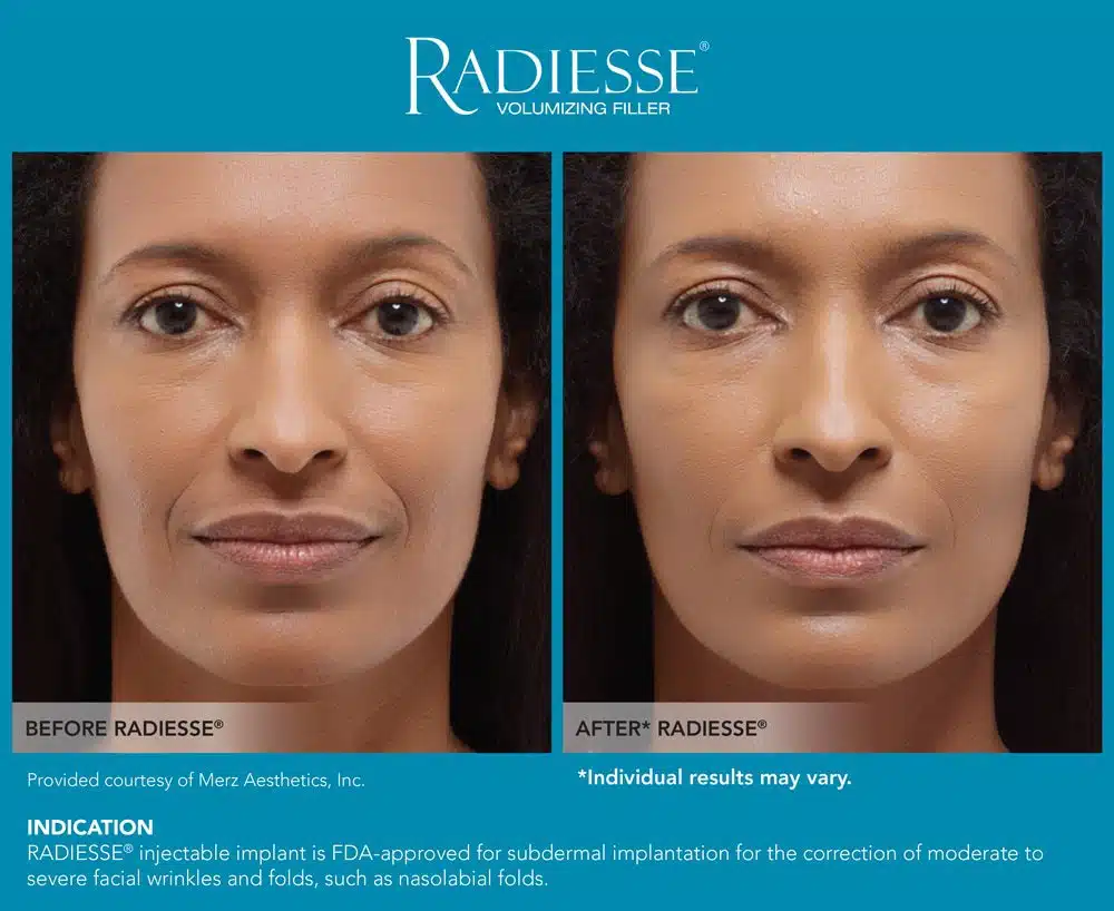 Dermal fillers procedure with Radiesse® can produce a long-lasting result. Dr, Sean Doherty | Boston, MA.
