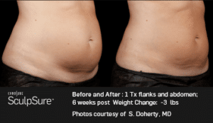 Non Surgical Body Sculpting Procedures in Boston, MA