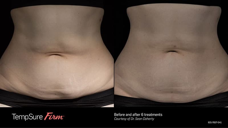 Before and after photo of TempSure in Boston | Boston Plastic Surgery by Dr, Sean Doherty